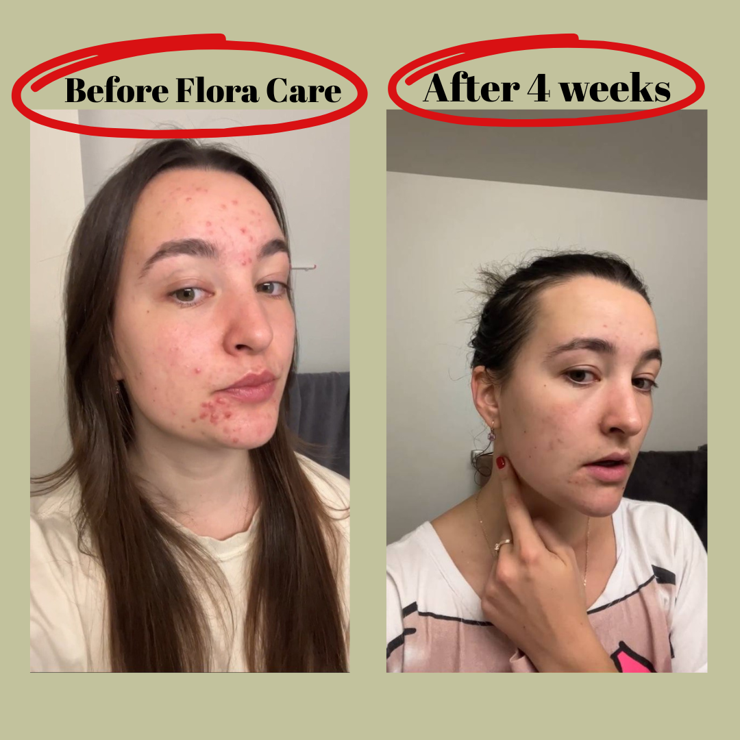 flora care before and after on skin